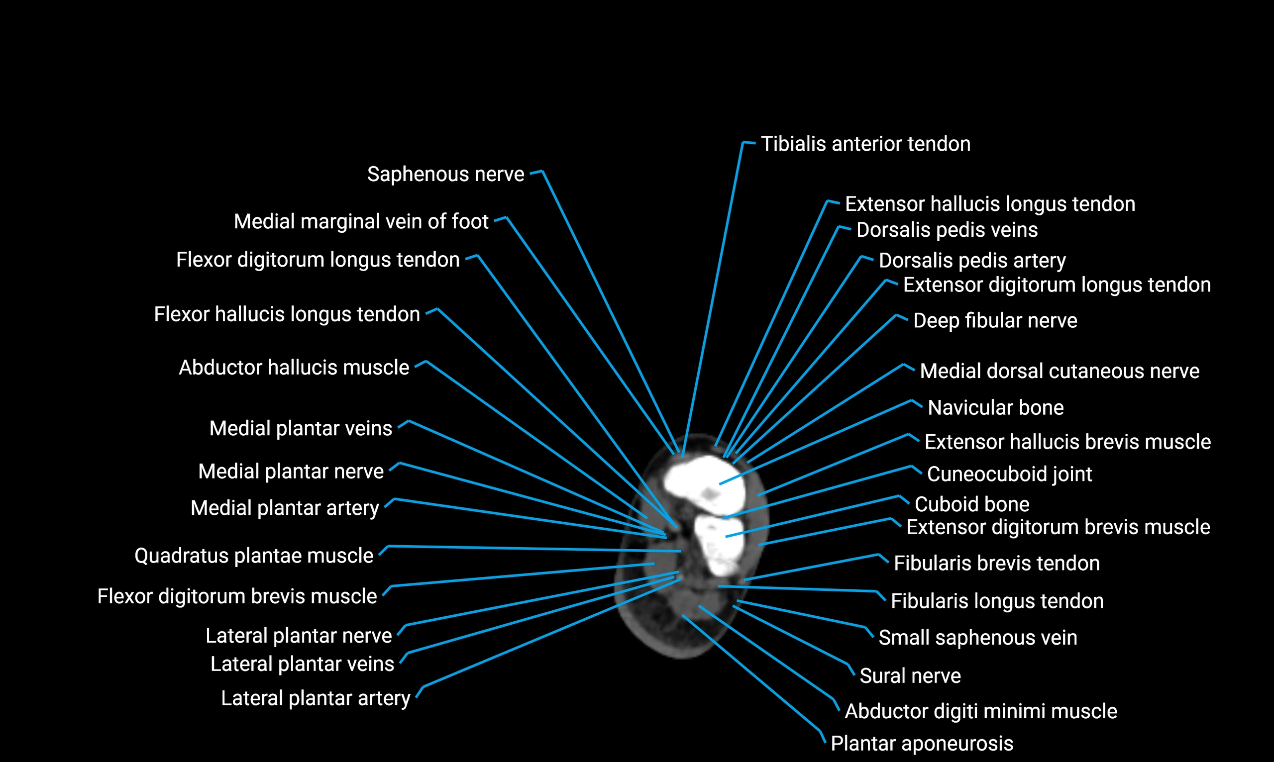 CT lower limb axial cross sectional anatomy labelled image 177 (2).webp